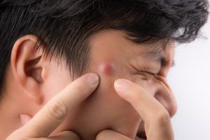Hydrogren Peroxide to Treat Acne and Scars