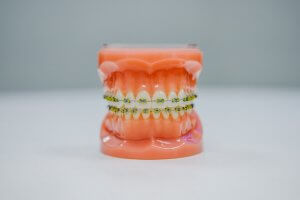 How to Clean Invisalign Trays With Hydrogen Peroxide