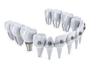 Can You Rinse Braces With Hydrogen Peroxide?