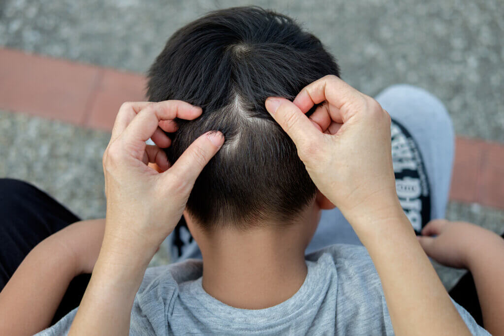 Effectiveness of Hydrogen Peroxide for Head Lice