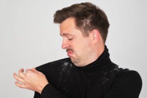 Hydrogen Peroxide for Dandruff Treatment